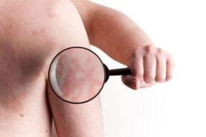 Eczema skin with magnifying glass